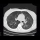 Fungal infection of lung, mycosis: CT - Computed tomography